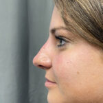 Non-surgical Rhinoplasty Before & After Patient #932