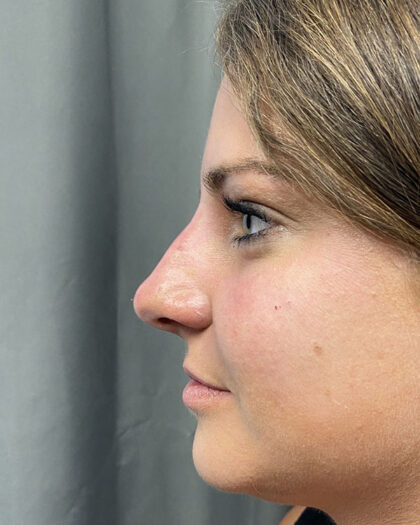 Non-surgical Rhinoplasty Before & After Patient #932