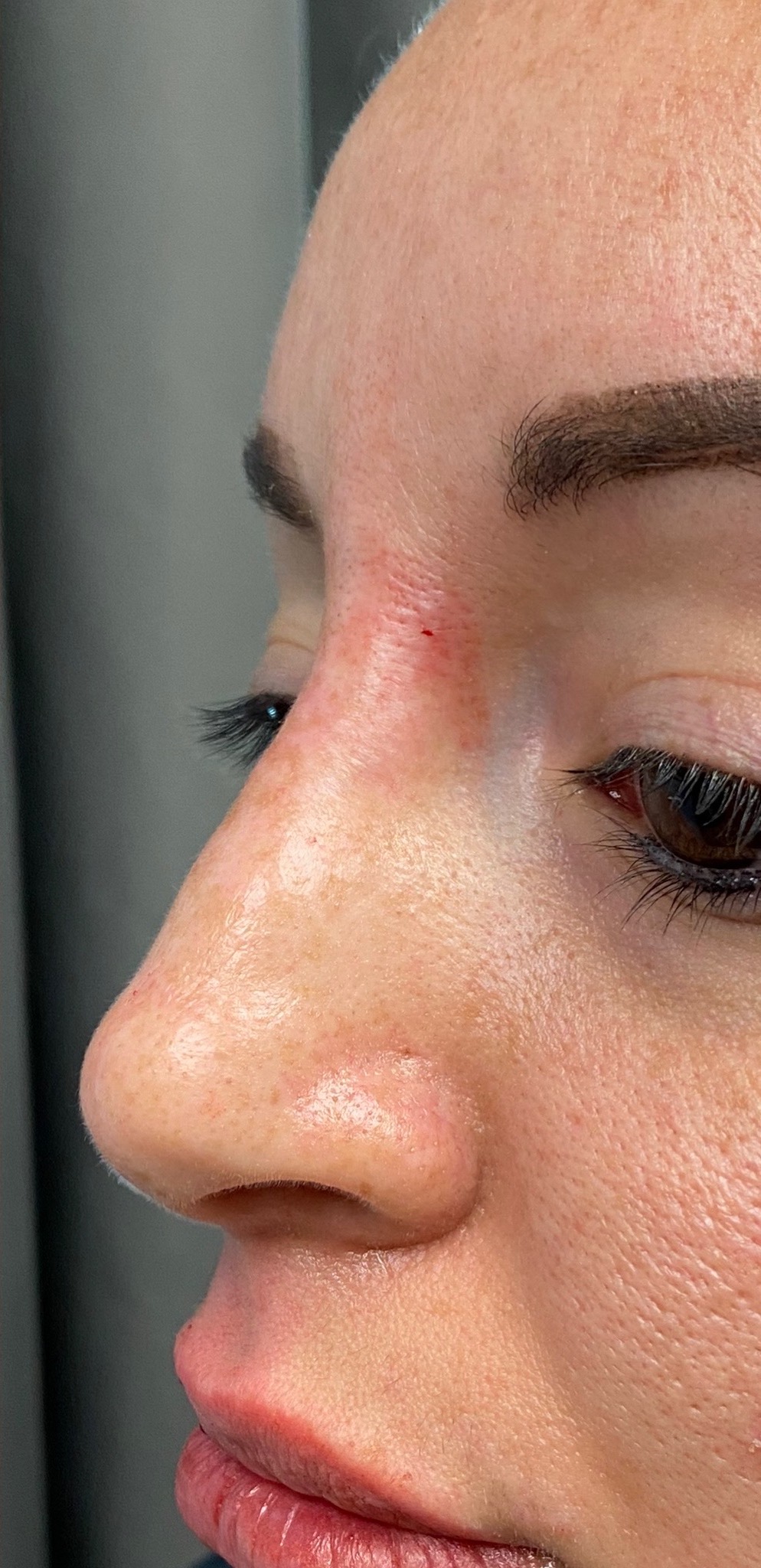 Non-surgical Rhinoplasty Before & After Patient #935