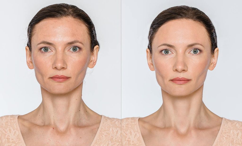 Pretty woman before and after.   Deep laser resurfacing. Alluring Aesthetics.