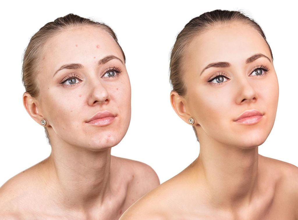Before and after young lady acne intense pulse light treatment Alluring Aesthetics.