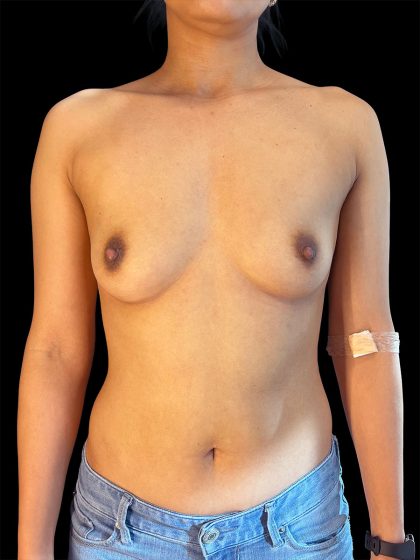 Breast Augmentation Before & After Patient #1636
