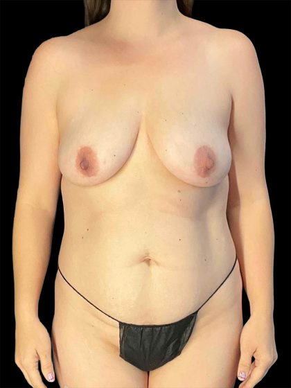 Liposuction Before & After Patient #1644