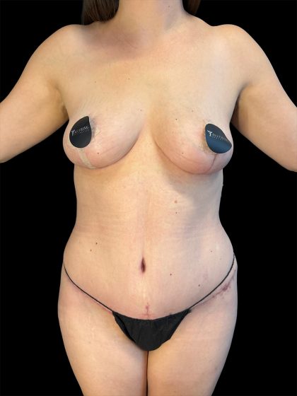 Liposuction Before & After Patient #1644